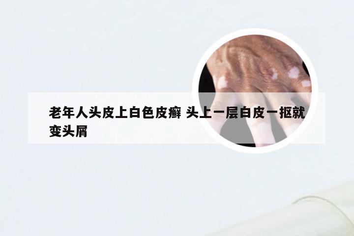 老年人头皮上白色皮癣 头上一层白皮一抠就变头屑