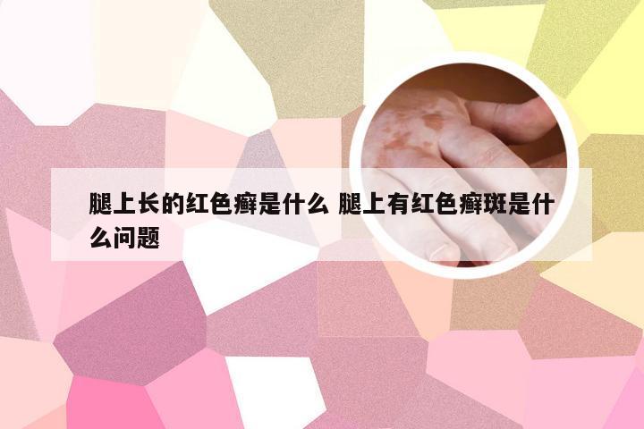 腿上长的红色癣是什么 腿上有红色癣斑是什么问题