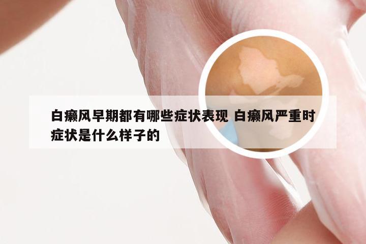 白癞风早期都有哪些症状表现 白癞风严重时症状是什么样子的