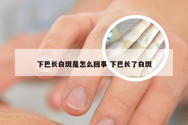 下巴长白斑是怎么回事 下巴长了白斑