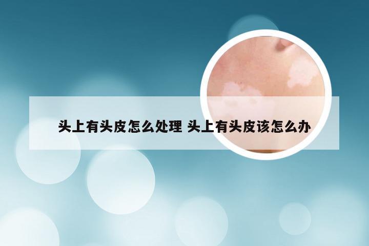 头上有头皮怎么处理 头上有头皮该怎么办