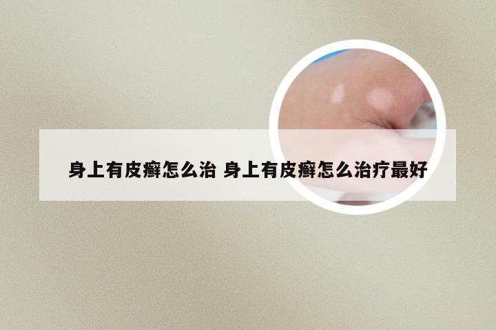 身上有皮癣怎么治 身上有皮癣怎么治疗最好