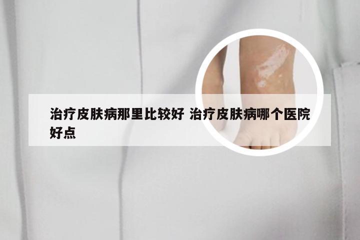治疗皮肤病那里比较好 治疗皮肤病哪个医院好点