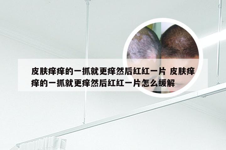 皮肤痒痒的一抓就更痒然后红红一片 皮肤痒痒的一抓就更痒然后红红一片怎么缓解