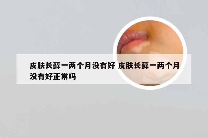 皮肤长藓一两个月没有好 皮肤长藓一两个月没有好正常吗