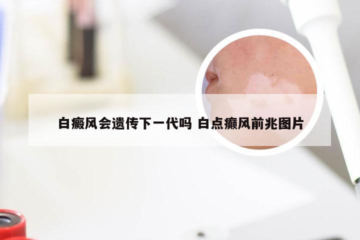 白癜风会遗传下一代吗 白点癫风前兆图片