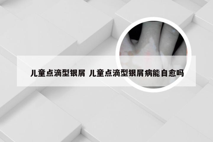 儿童点滴型银屑 儿童点滴型银屑病能自愈吗