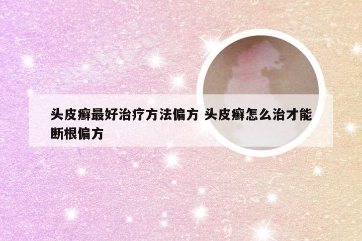 头皮癣最好治疗方法偏方 头皮癣怎么治才能断根偏方