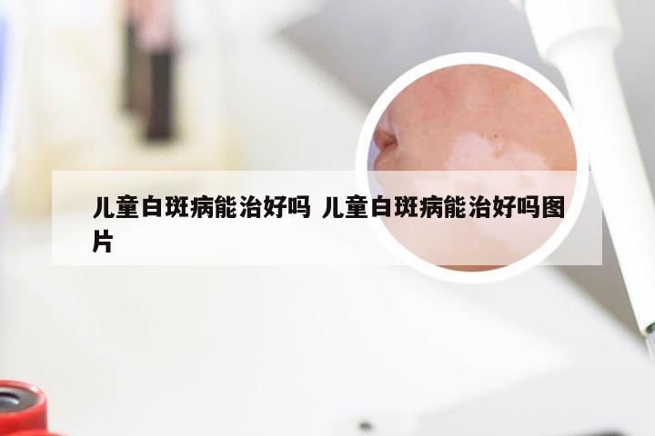 儿童白斑病能治好吗 儿童白斑病能治好吗图片