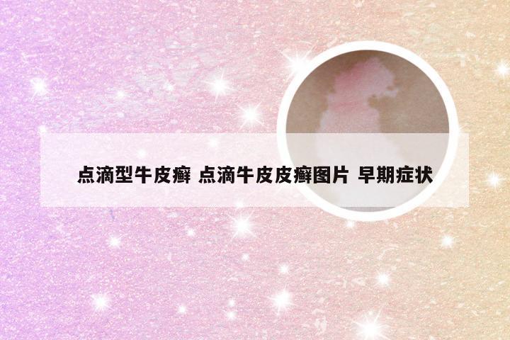 点滴型牛皮癣 点滴牛皮皮癣图片 早期症状