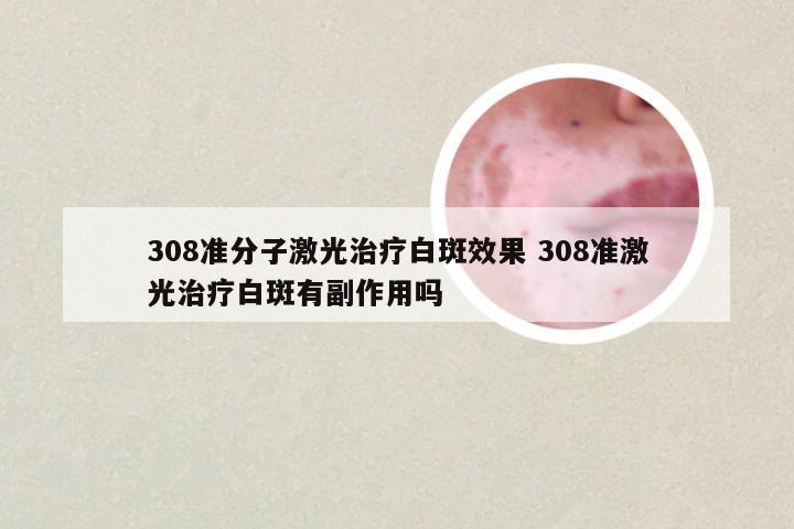 308准分子激光治疗白斑效果 308准激光治疗白斑有副作用吗