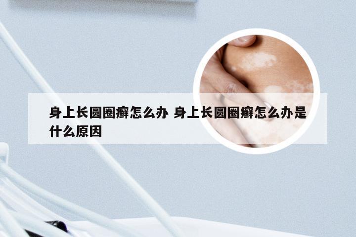 身上长圆圈癣怎么办 身上长圆圈癣怎么办是什么原因