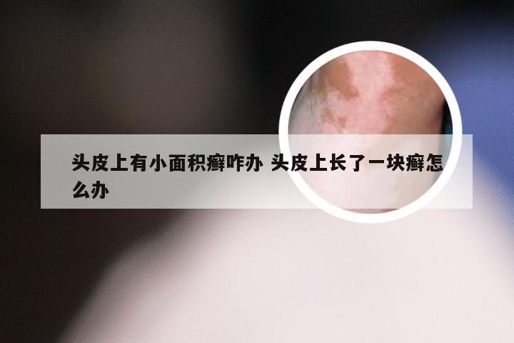 头皮上有小面积癣咋办 头皮上长了一块癣怎么办