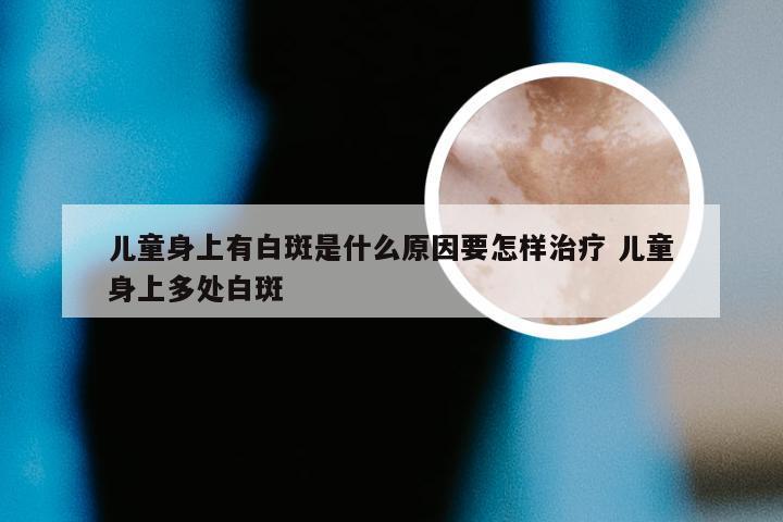 儿童身上有白斑是什么原因要怎样治疗 儿童身上多处白斑