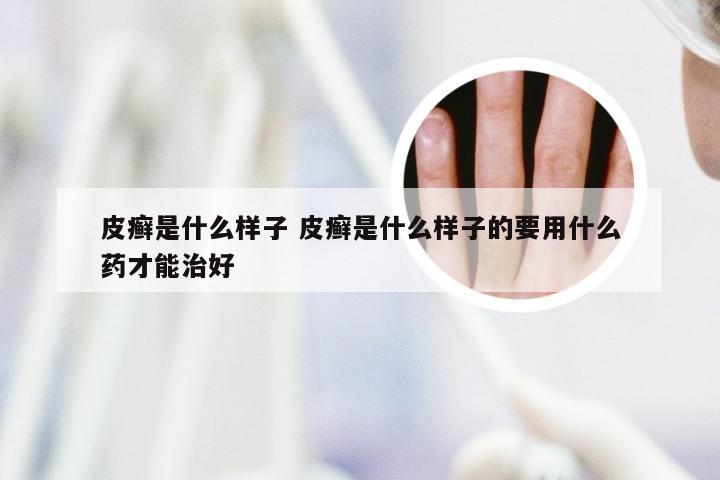 皮癣是什么样子 皮癣是什么样子的要用什么药才能治好