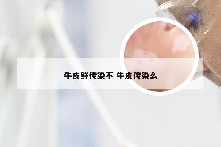 牛皮鲜传染不 牛皮传染么