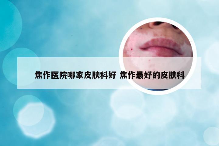 焦作医院哪家皮肤科好 焦作最好的皮肤科
