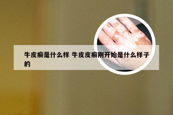 牛皮癣是什么样 牛皮皮癣刚开始是什么样子的