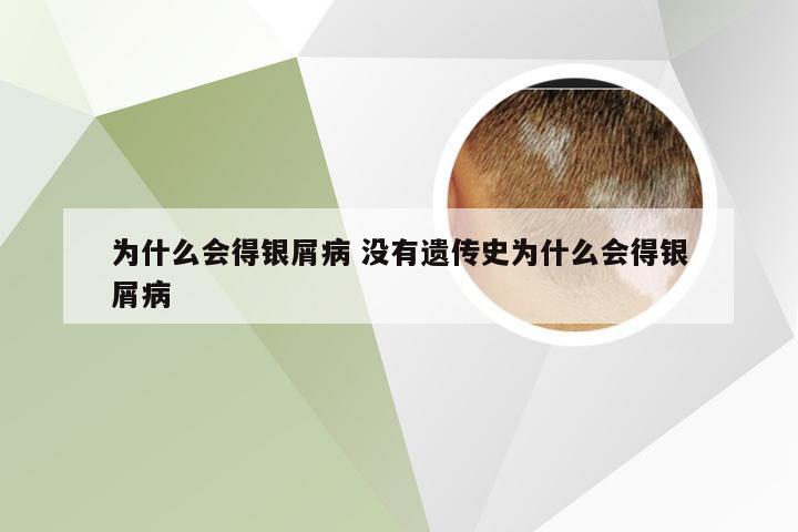 为什么会得银屑病 没有遗传史为什么会得银屑病