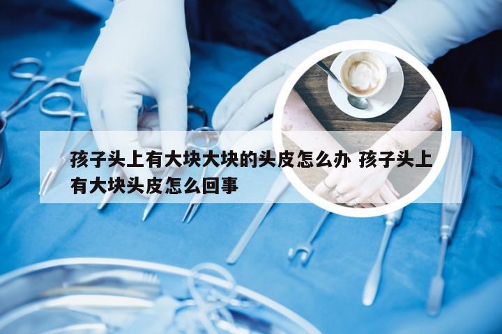 孩子头上有大块大块的头皮怎么办 孩子头上有大块头皮怎么回事