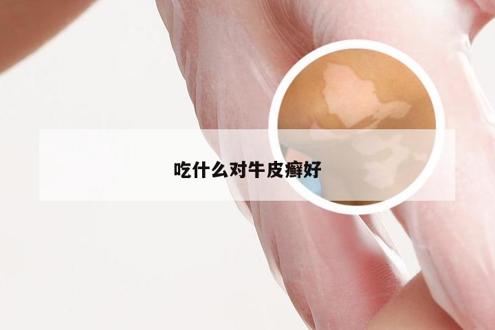 吃什么对牛皮癣好