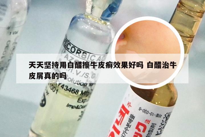 天天坚持用白醋擦牛皮癣效果好吗 白醋治牛皮屑真的吗