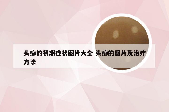 头癣的初期症状图片大全 头癣的图片及治疗方法