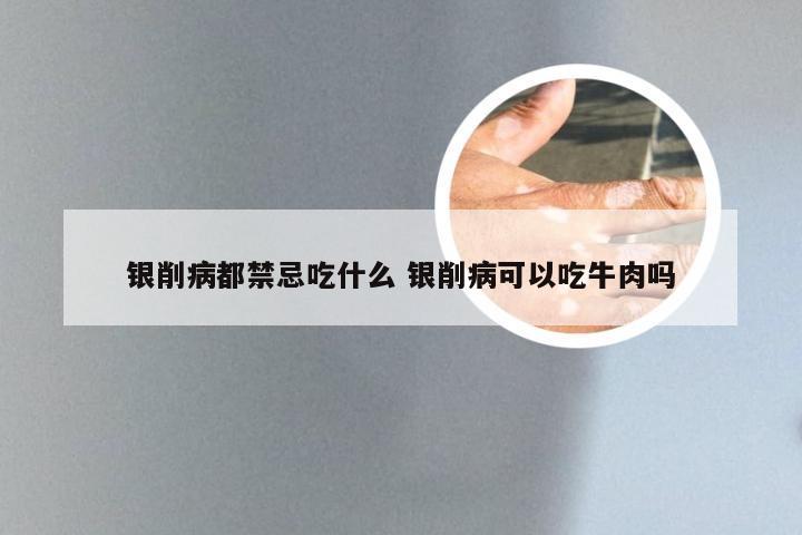 银削病都禁忌吃什么 银削病可以吃牛肉吗