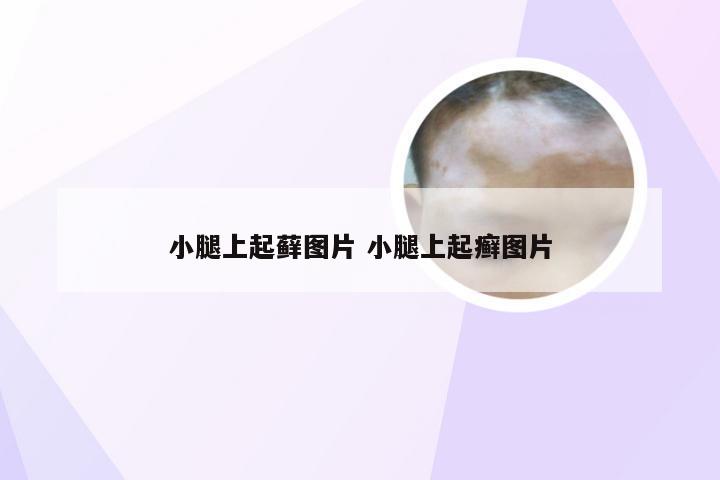 小腿上起藓图片 小腿上起癣图片