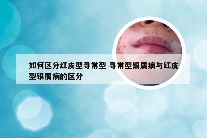 如何区分红皮型寻常型 寻常型银屑病与红皮型银屑病的区分