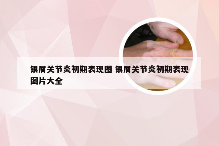 银屑关节炎初期表现图 银屑关节炎初期表现图片大全