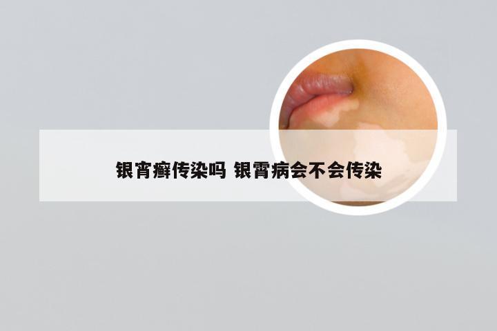 银宵癣传染吗 银霄病会不会传染