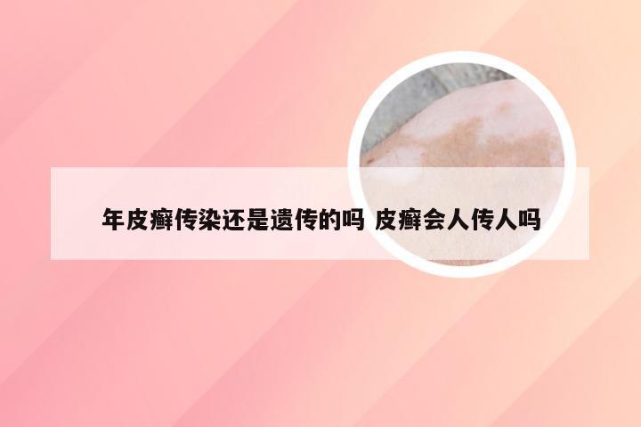 年皮癣传染还是遗传的吗 皮癣会人传人吗