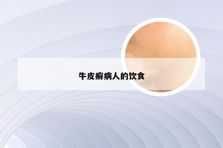 牛皮癣病人的饮食
