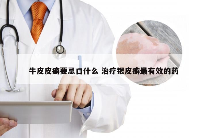 牛皮皮癣要忌口什么 治疗银皮癣最有效的药