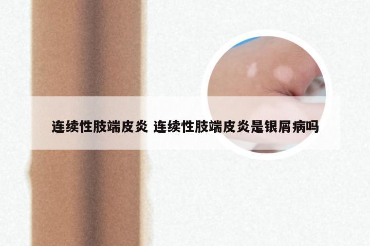 连续性肢端皮炎 连续性肢端皮炎是银屑病吗