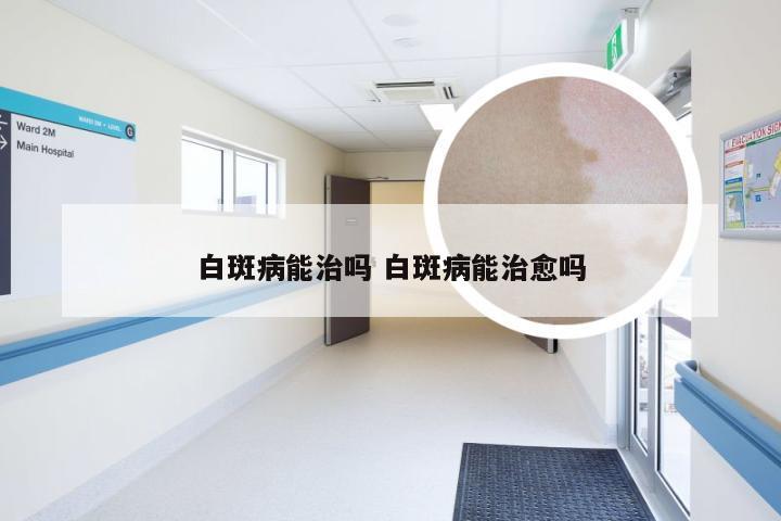 白斑病能治吗 白斑病能治愈吗