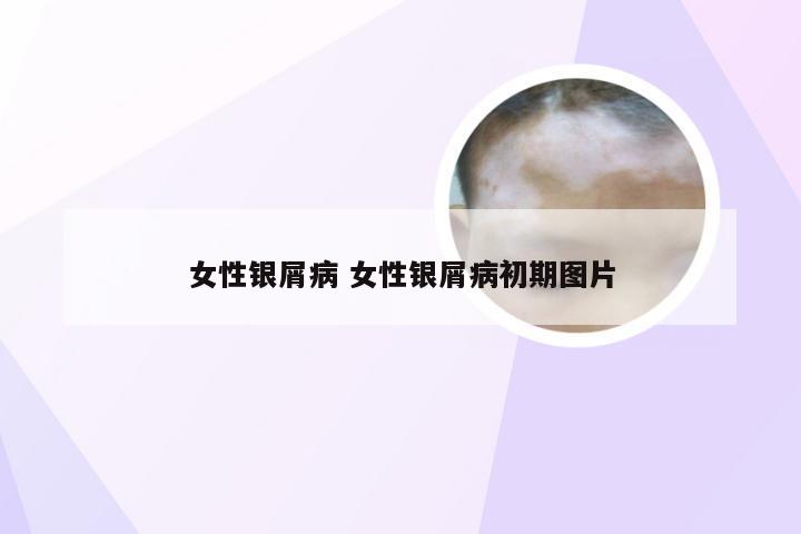 女性银屑病 女性银屑病初期图片
