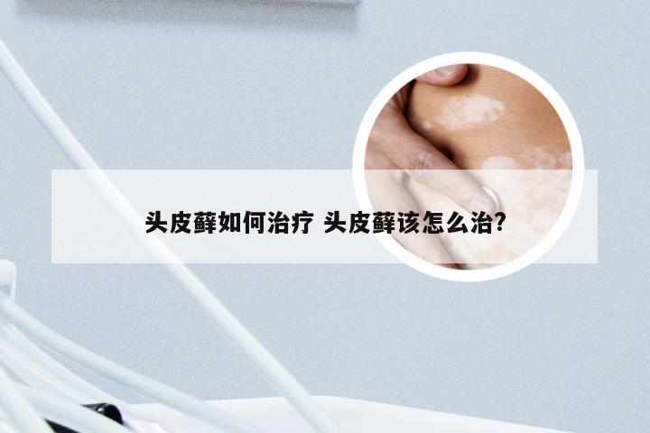 头皮藓如何治疗 头皮藓该怎么治?