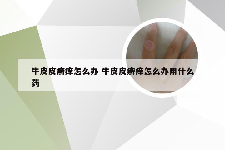 牛皮皮癣痒怎么办 牛皮皮癣痒怎么办用什么药