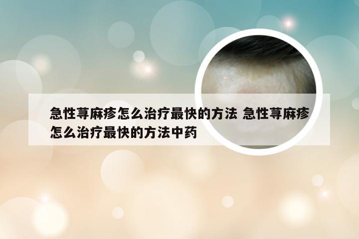 急性荨麻疹怎么治疗最快的方法 急性荨麻疹怎么治疗最快的方法中药