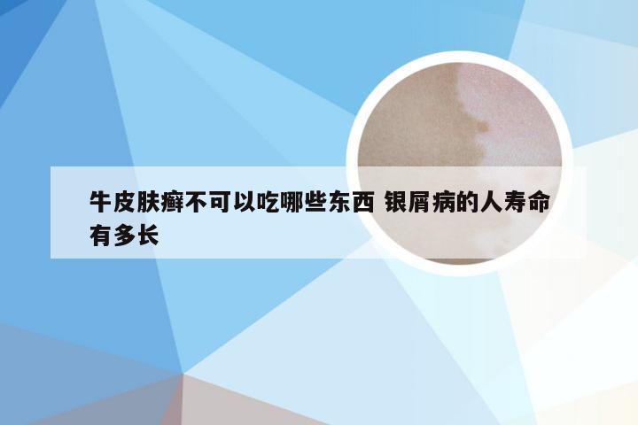 牛皮肤癣不可以吃哪些东西 银屑病的人寿命有多长