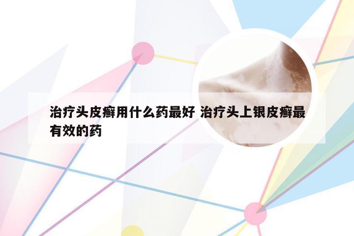 治疗头皮癣用什么药最好 治疗头上银皮癣最有效的药