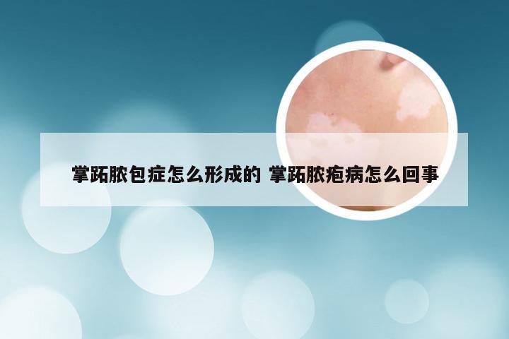 掌跖脓包症怎么形成的 掌跖脓疱病怎么回事