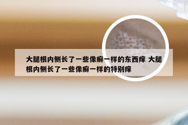 大腿根内侧长了一些像癣一样的东西痒 大腿根内侧长了一些像癣一样的特别痒