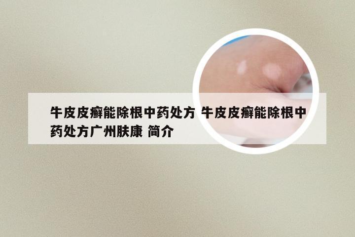 牛皮皮癣能除根中药处方 牛皮皮癣能除根中药处方广州肤康 简介