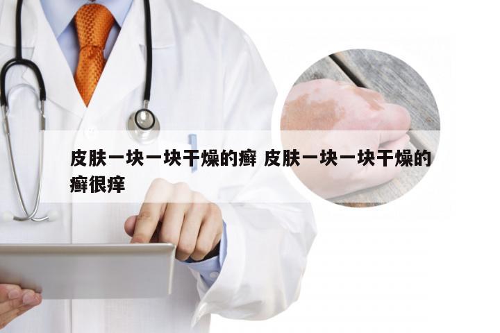 皮肤一块一块干燥的癣 皮肤一块一块干燥的癣很痒