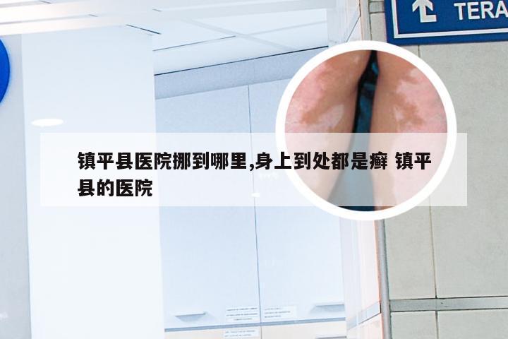 镇平县医院挪到哪里,身上到处都是癣 镇平县的医院