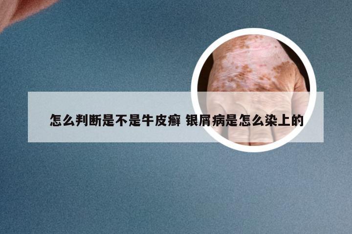 怎么判断是不是牛皮癣 银屑病是怎么染上的