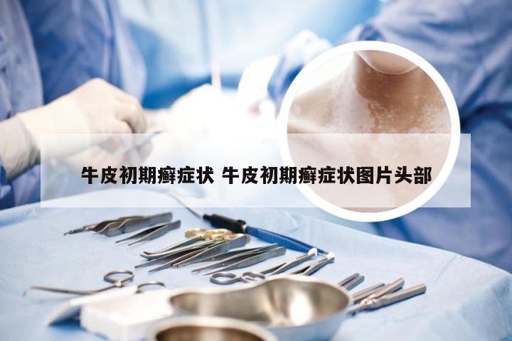 牛皮初期癣症状 牛皮初期癣症状图片头部